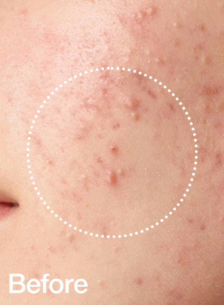 Anua - BHA 2% Milde Exfoliërende Toner
